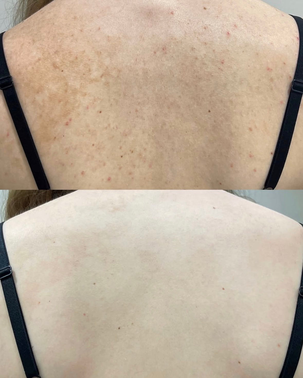 6X Ultimate Skin brightening complex six month course