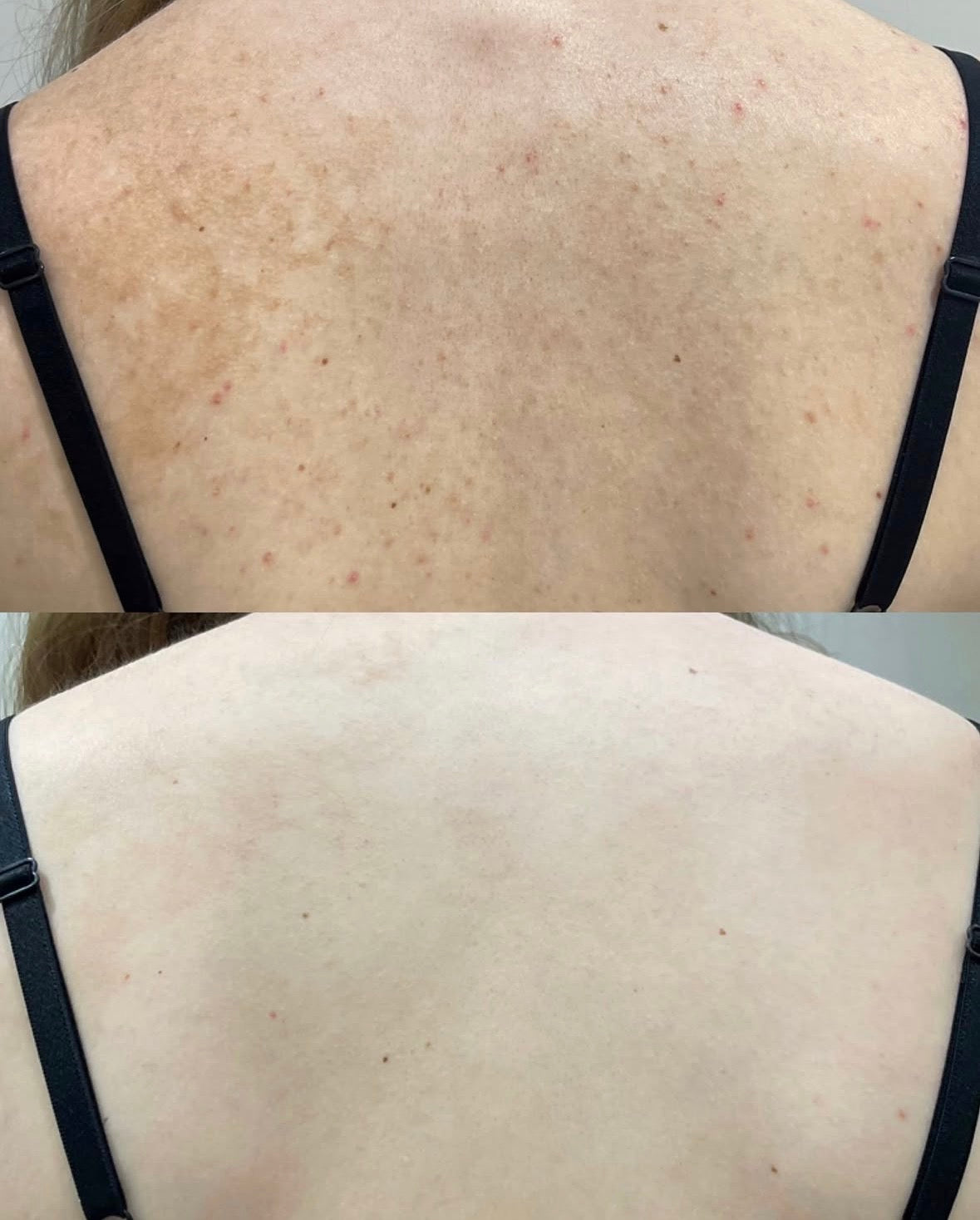 6X Ultimate Skin brightening complex six month course